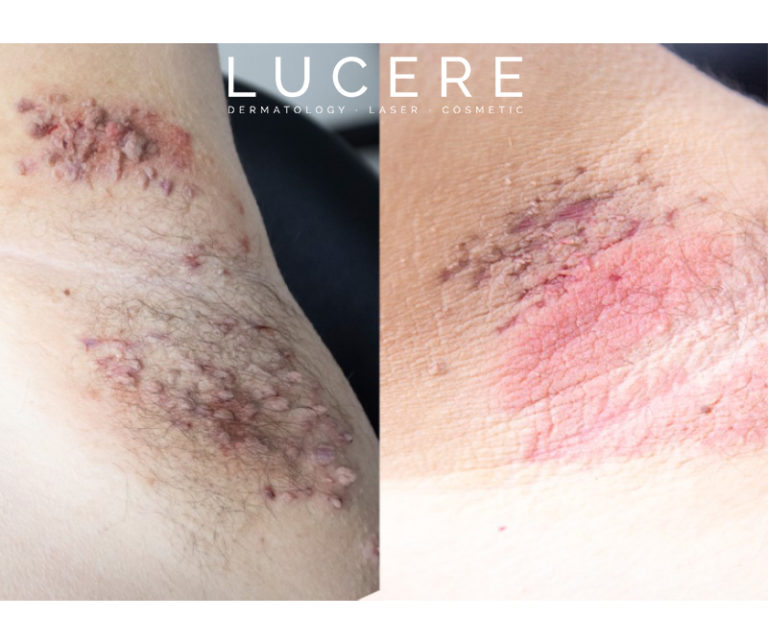 Skin tag removal before and after Edmonton