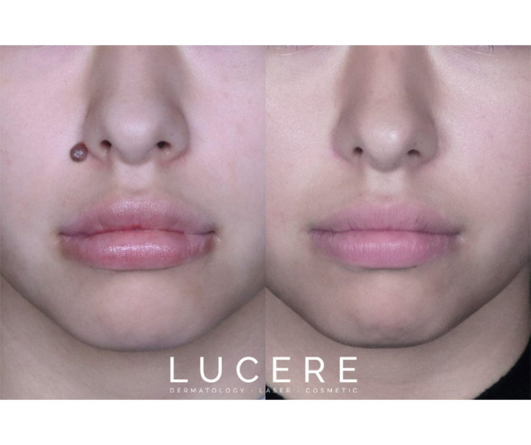 surgical mole removal before and after results