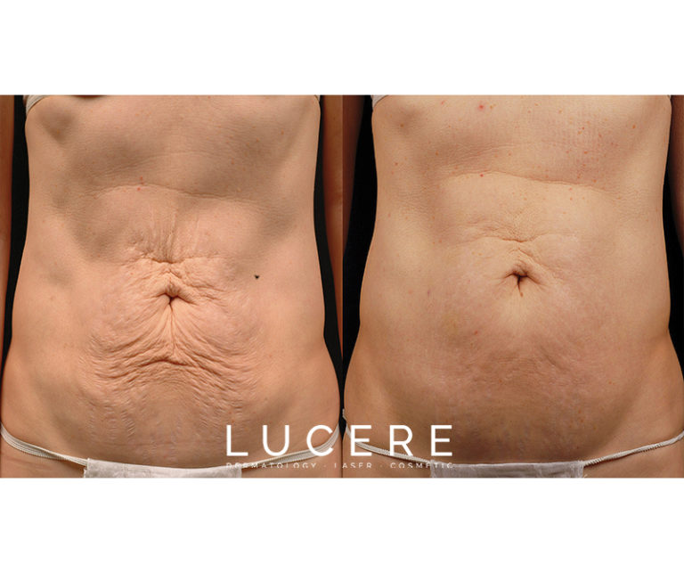 Thermage - Skin Tightening belly before and after