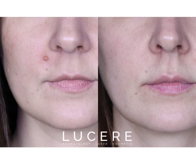 surgical mole removal before and after