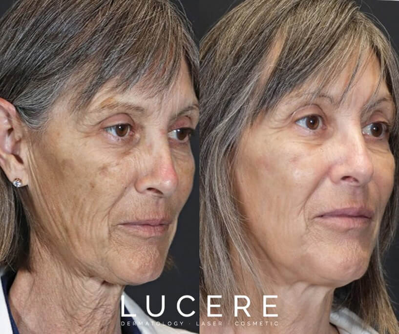  Lucere ThermaFrax laser treatment before and after