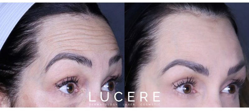 Botox injections for forehead lines