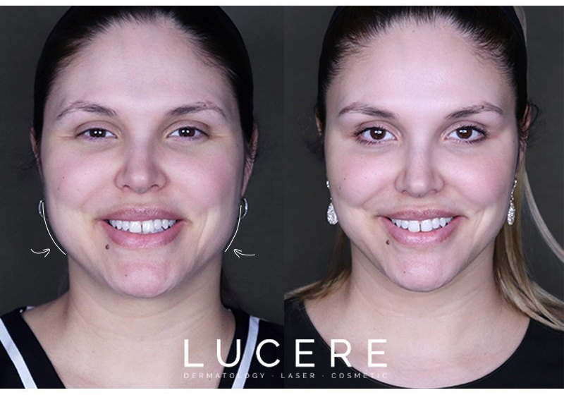 transformation with combining Botox & Filler