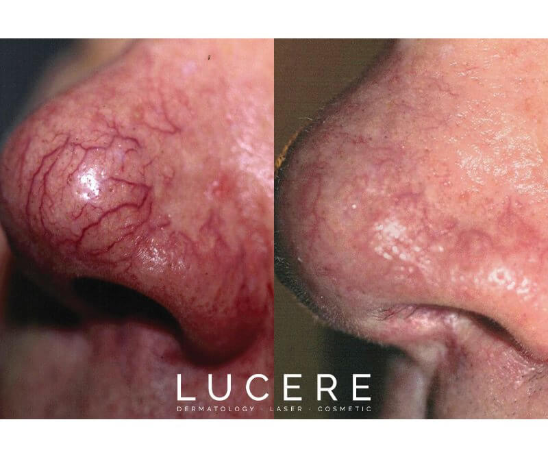nose veins treatment before and after