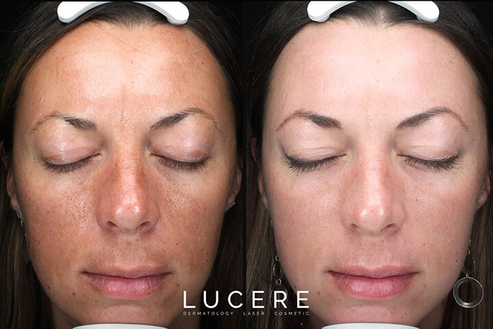 Lucere’s Fraxel Skin Resurfacing skin tightening treatment before and after