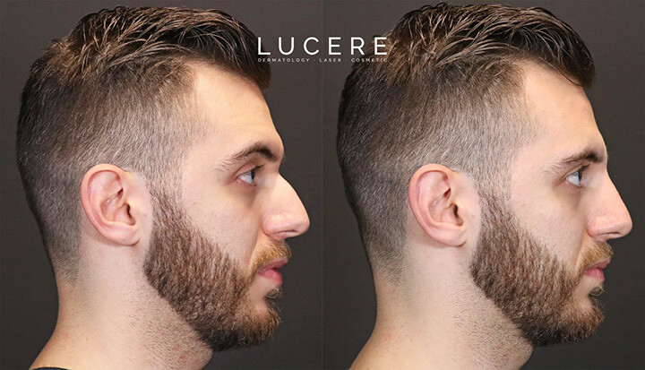 Liquid Nose Job before and after