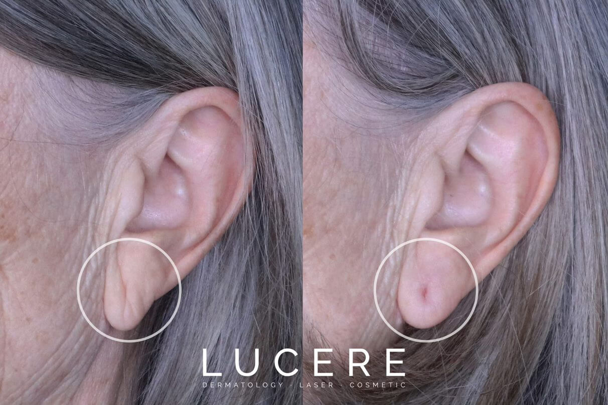 ear lobes dermal fillers before and after