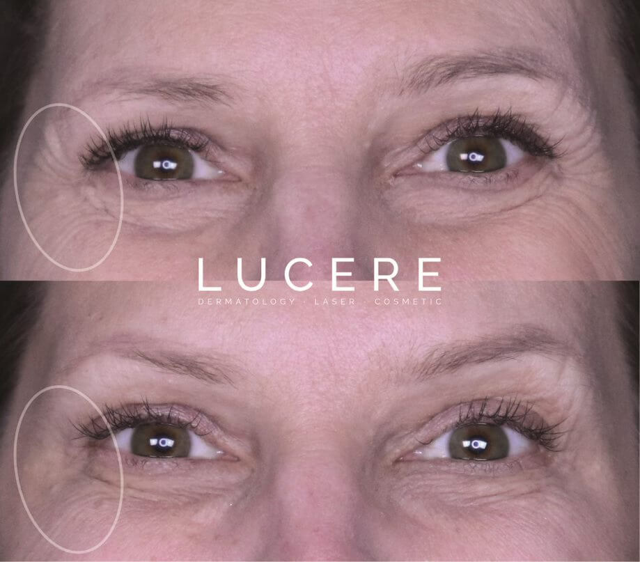 dermal fillers injections area around the eyes before and after