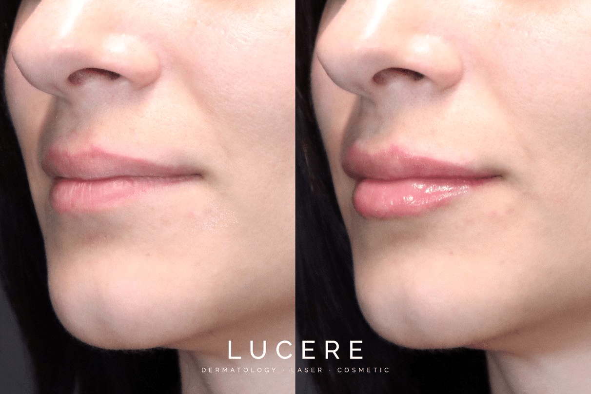  filler for fuller plumper lips