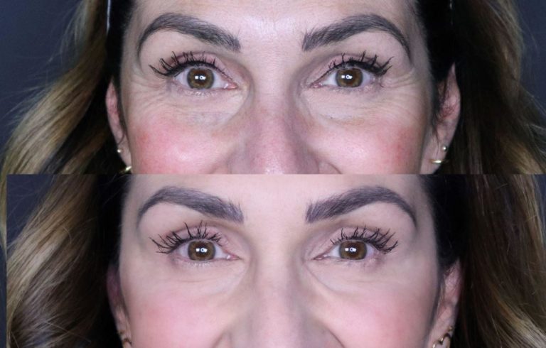 botox or dysport before and after