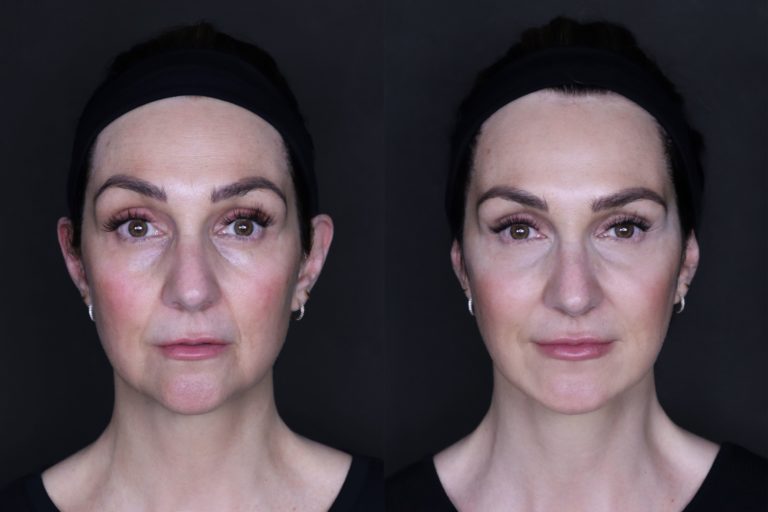 Botox before and after results