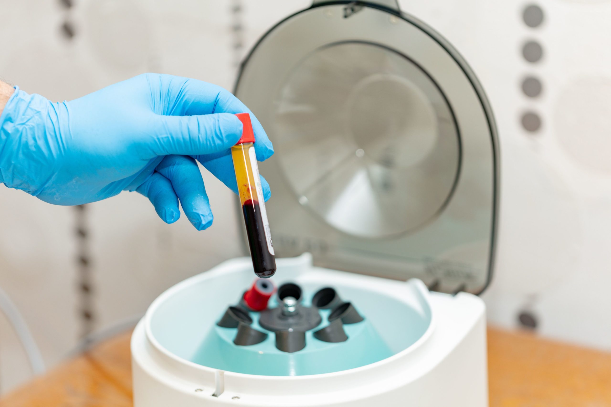 PRP-treatment at Lucere