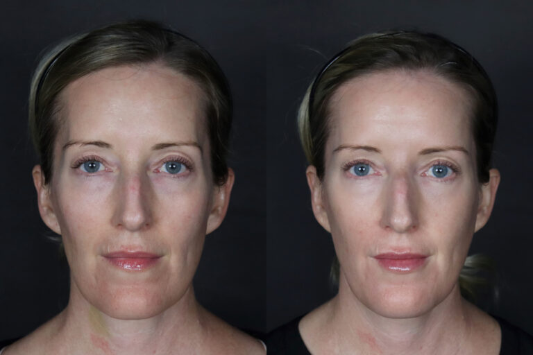 Filler Front side Before and After results