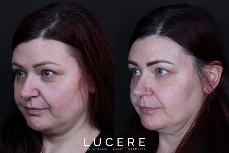 HIFU Treatment Edmonton Before and After Left Side