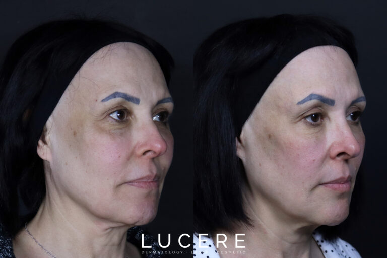 HIFU Before and After Right side