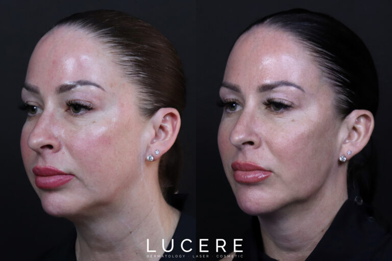 Left Side Before and After HIFU Treatment