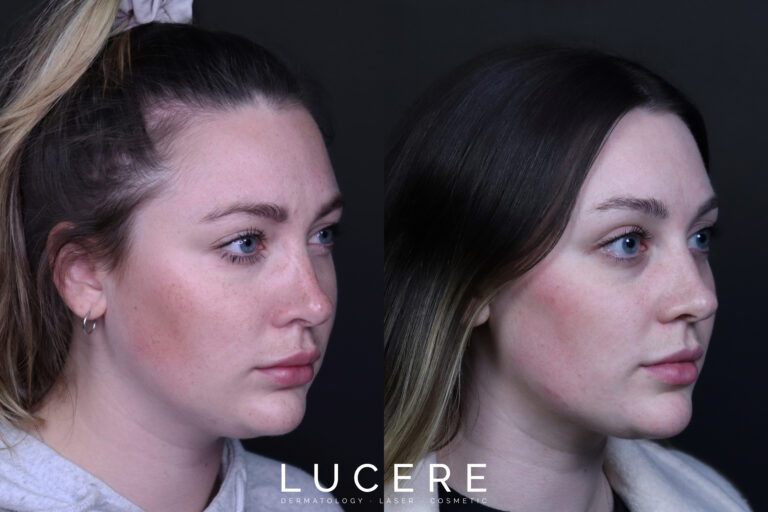 HIFU Before and After Laser Treatment