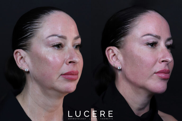 HIFU Laser Treatment Before and After