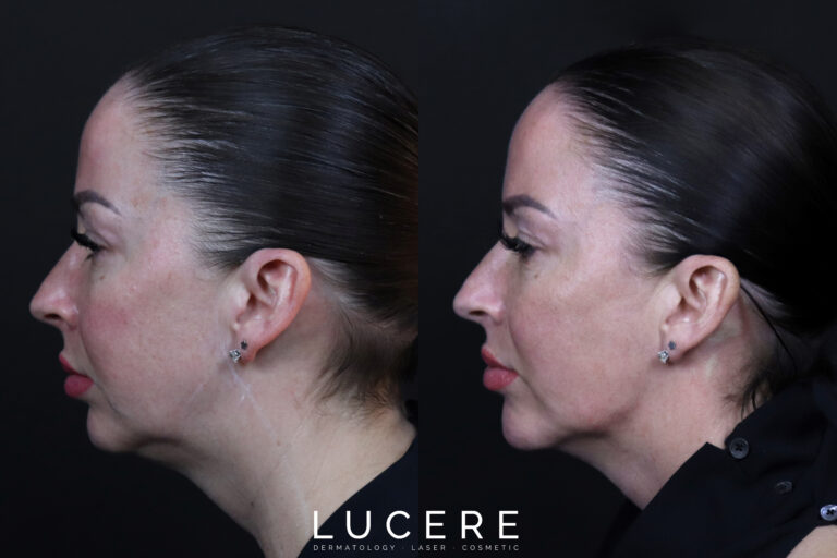 HIFU Tight before and after