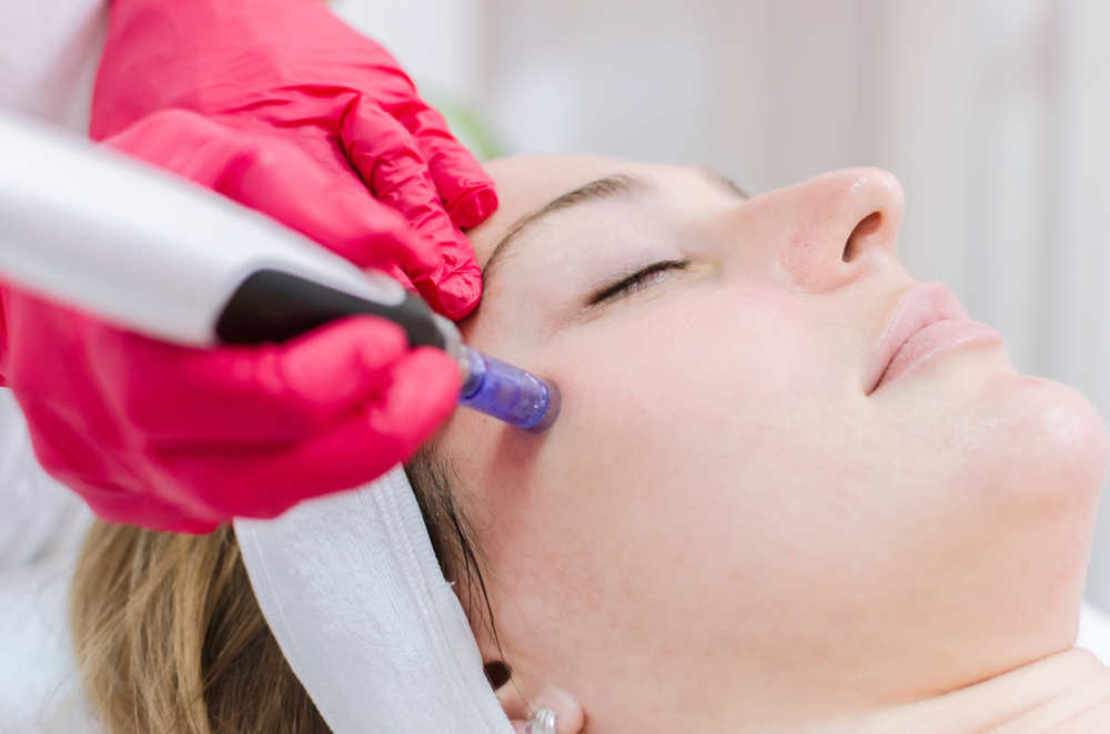 micro needling treatment by Lucere