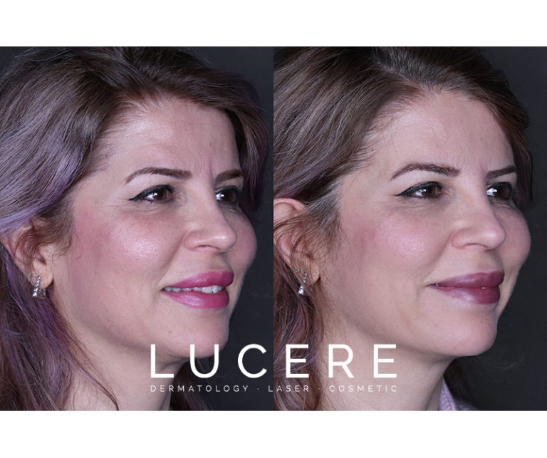 Face and Lips and Forehead Botox Before And After