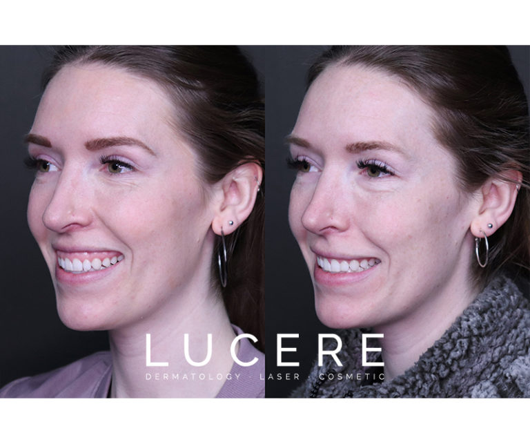 Botox Gummy Smile Before and After