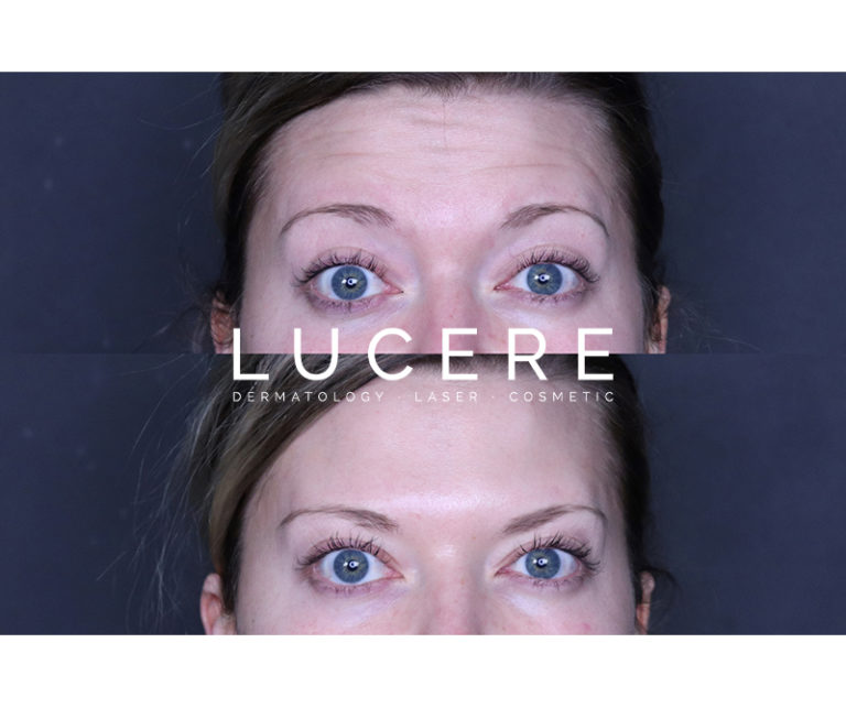 Botox for Forehead before and after