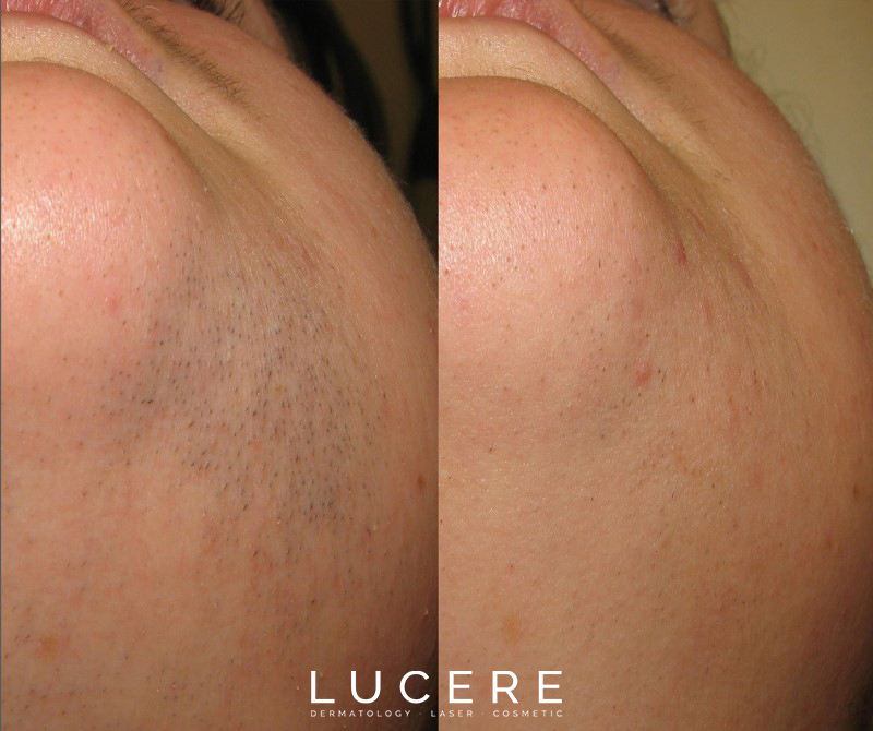 laser hair removal bikni lines before and after