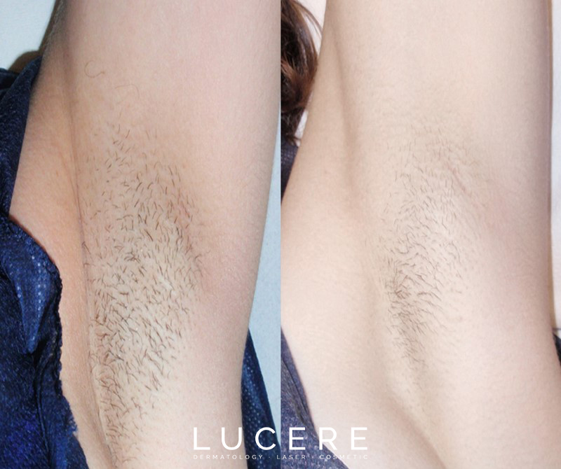 under arm laser hair removal before and after