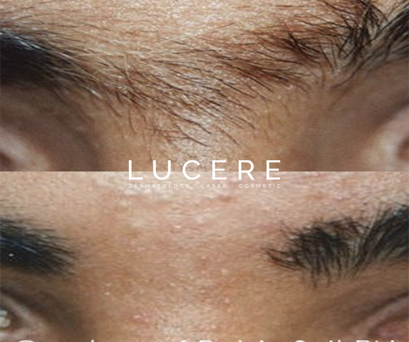 under eyebrow laser hair removal before and after