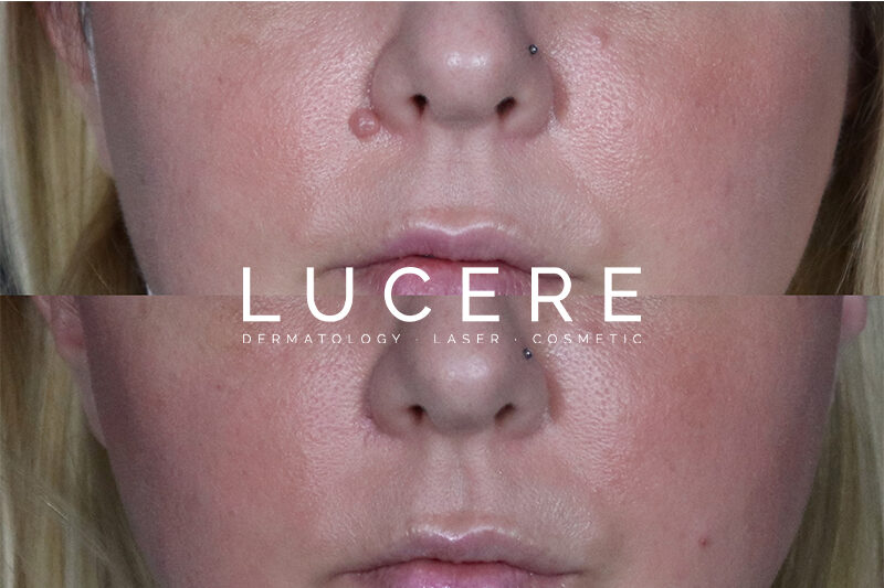 mole removal before and after