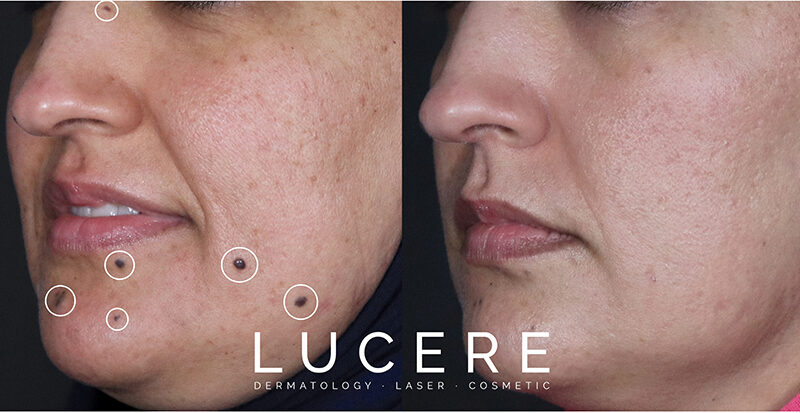 mole removal near cheeks before and after