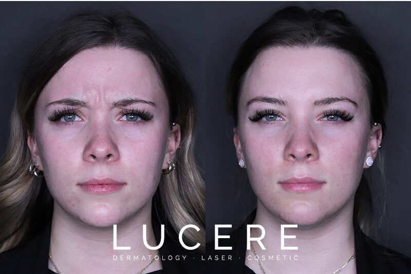 Forehead and Lipodissolve - B&A - Front Frown