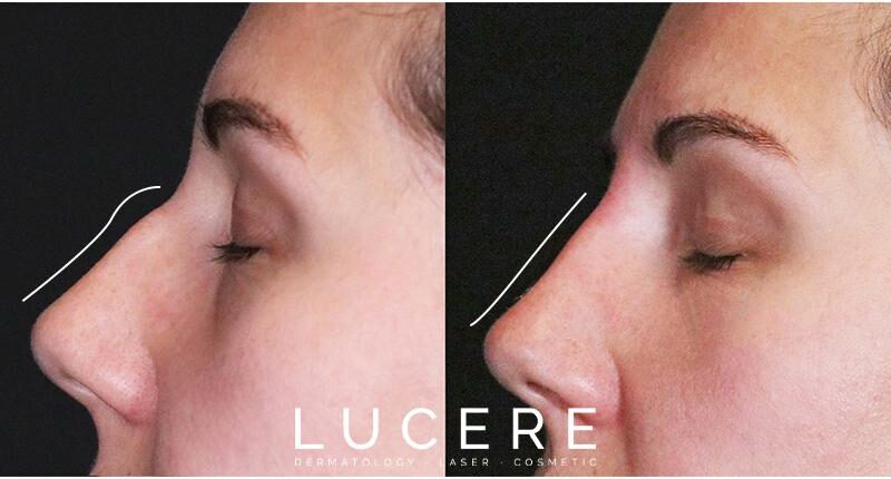 nose reshape before and after