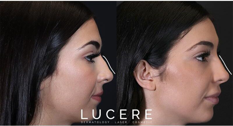 wide nose fix with botox injections