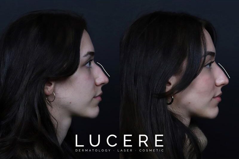 wide nose fix with Botox