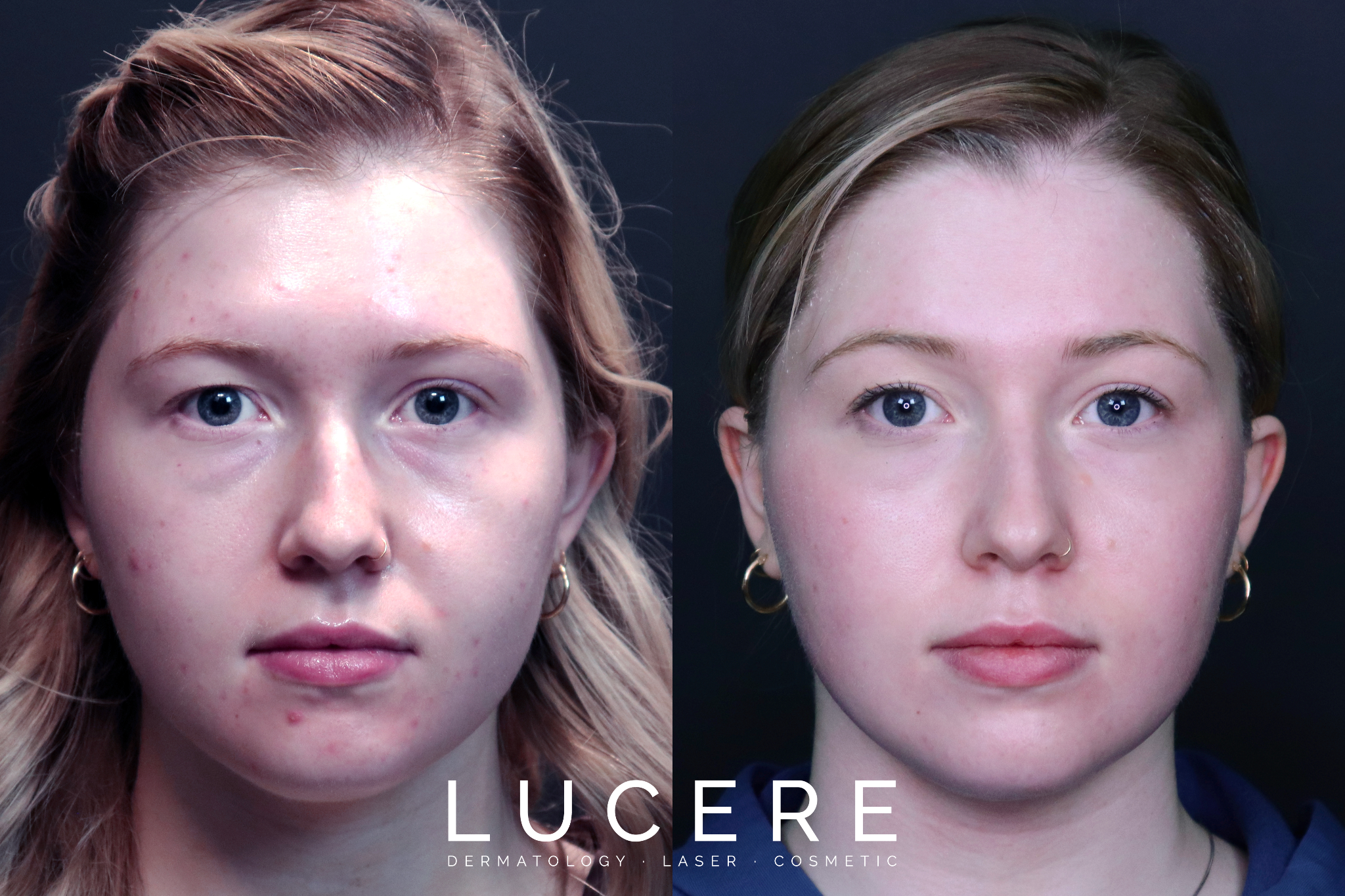 benefits of microdermabrasion for skin rejuvenation