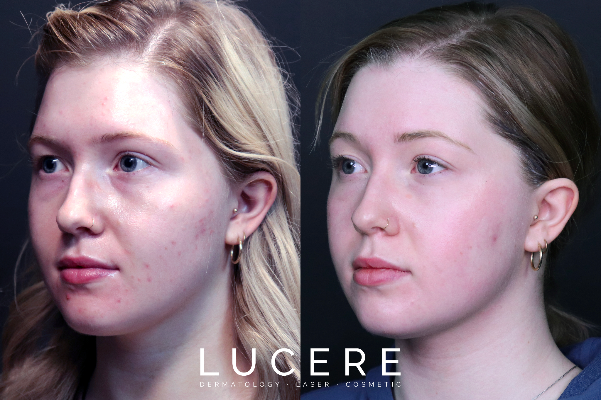 skin treatments before and after