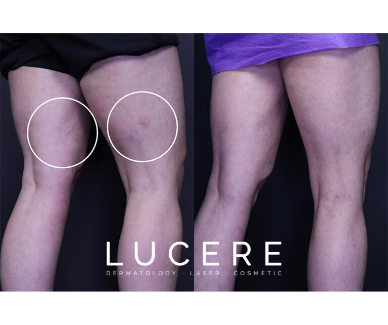 Endo Venous Laser Ablation (EVLA) leg Before and After