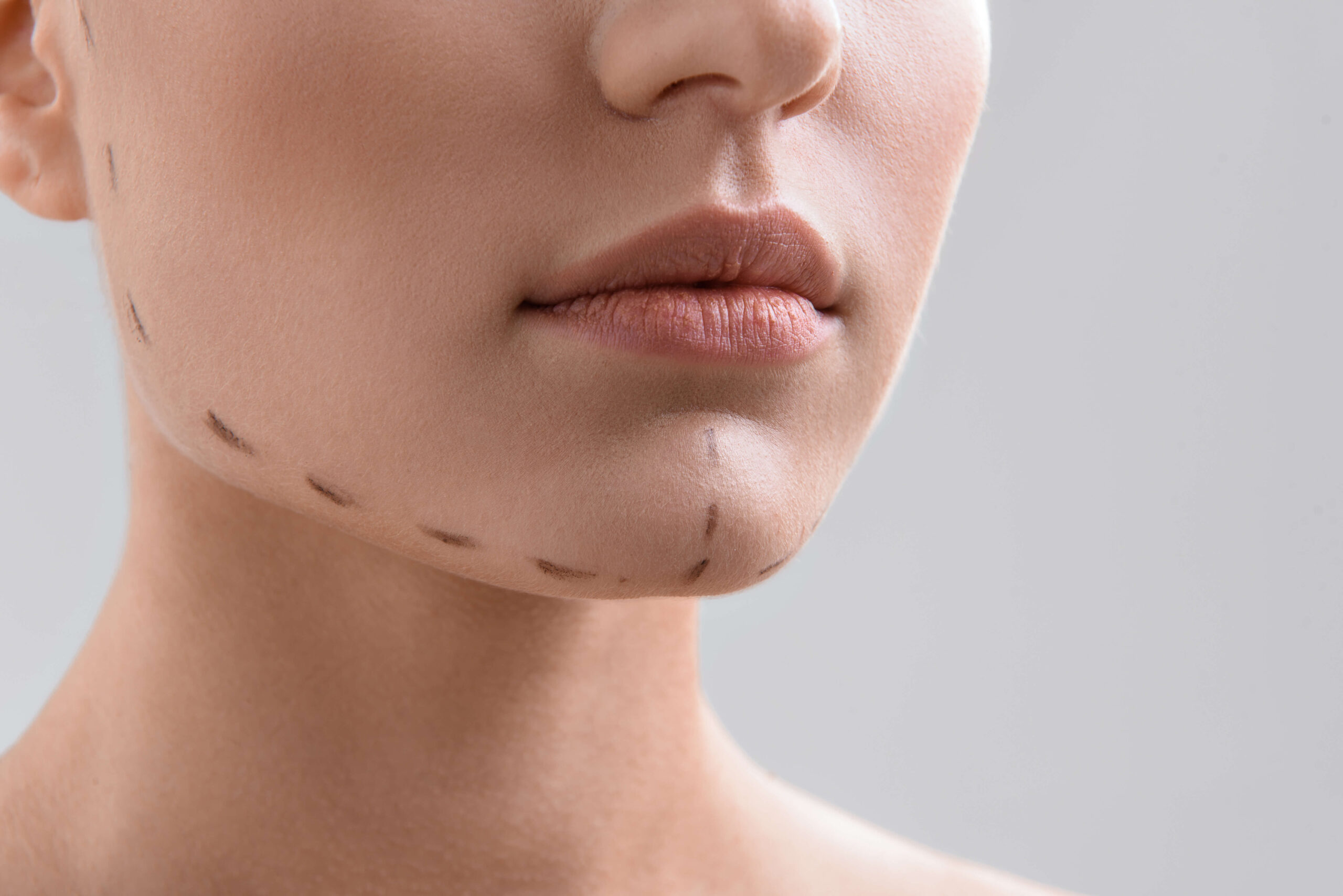 Genioplasty