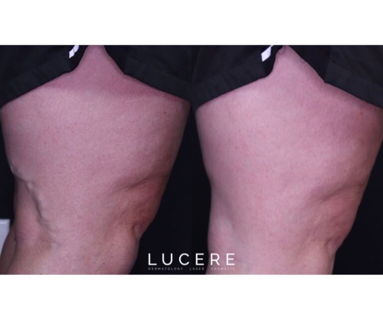 Endo Venous Laser Ablation before and after