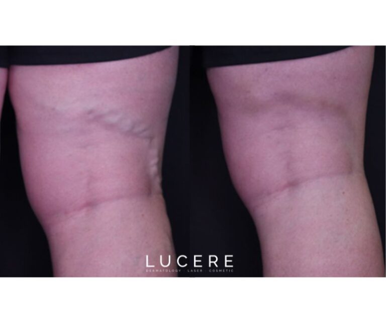 Endo Venous Laser Ablation before and after