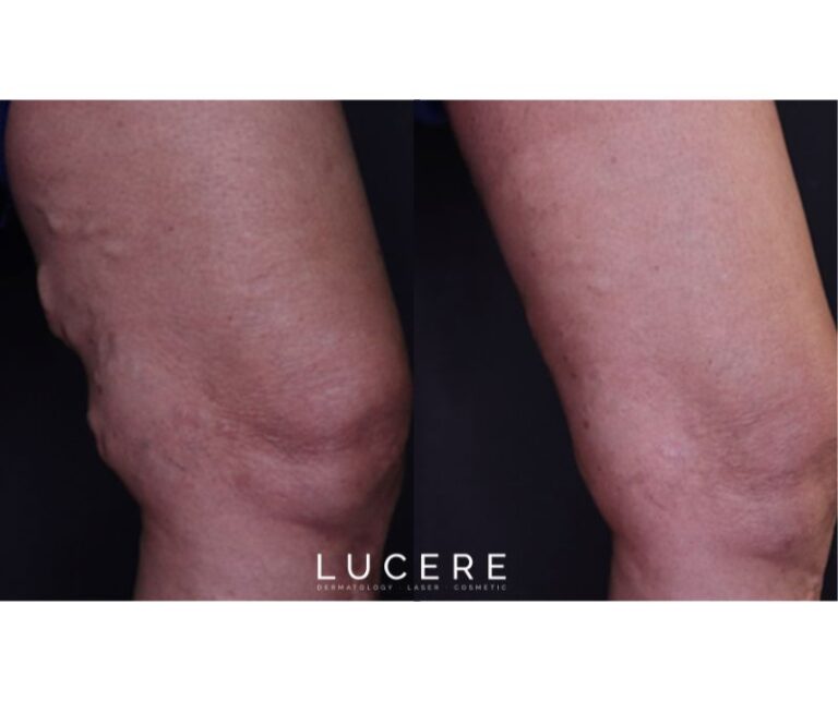 Endo Venous Laser Ablation before and after