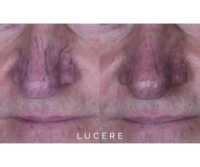 Endo Venous Laser Ablation results before and after