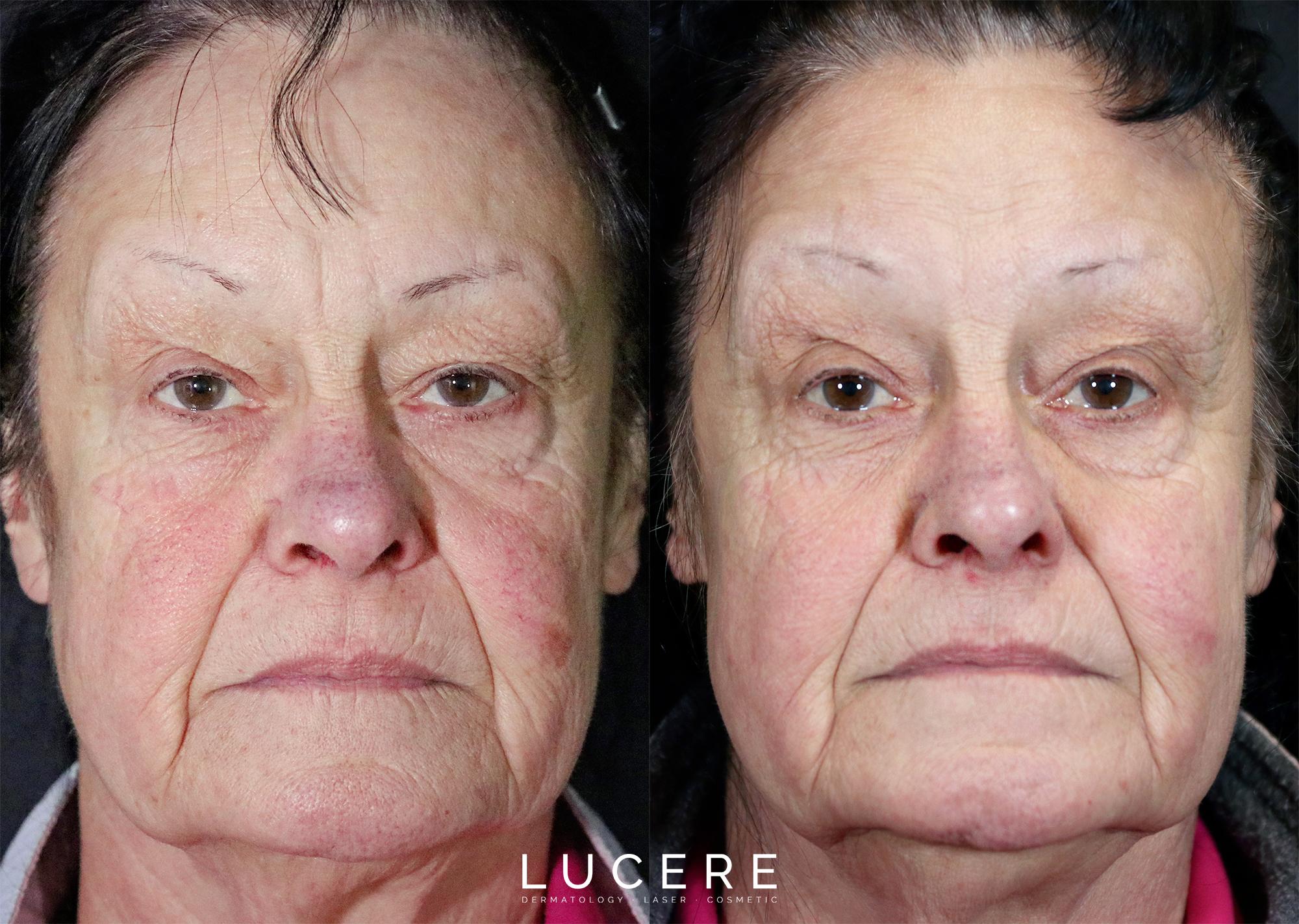 PICOFOCUS before and after