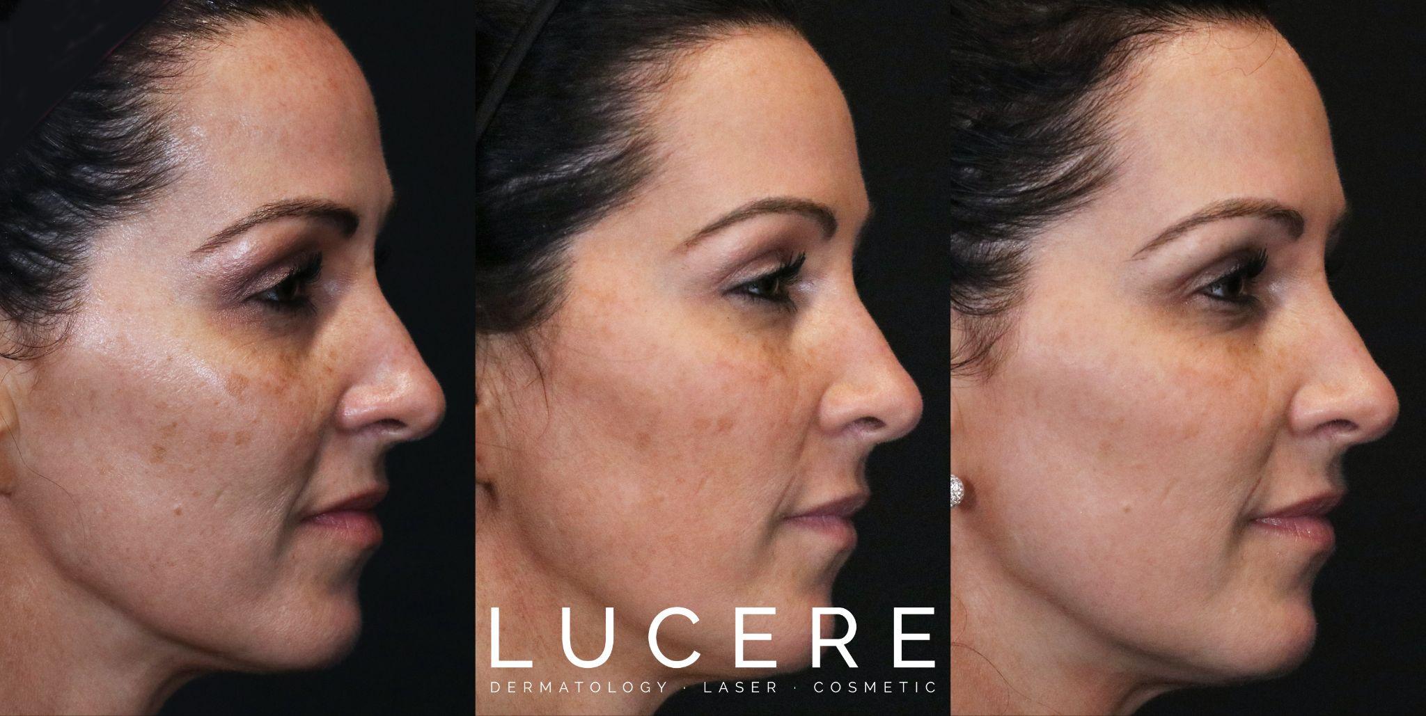 PICOFOCUS treatment before and after