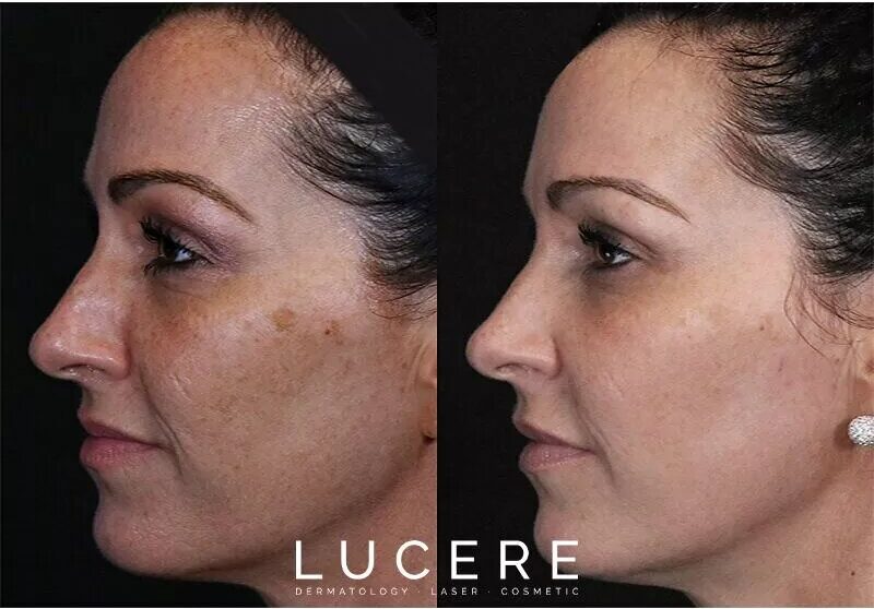 PicoSure before and after
