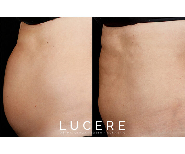 SculpSure Before and After_Side by Side_Female