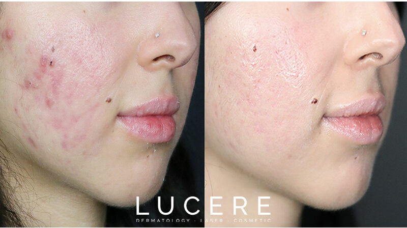 chemical peel before and after