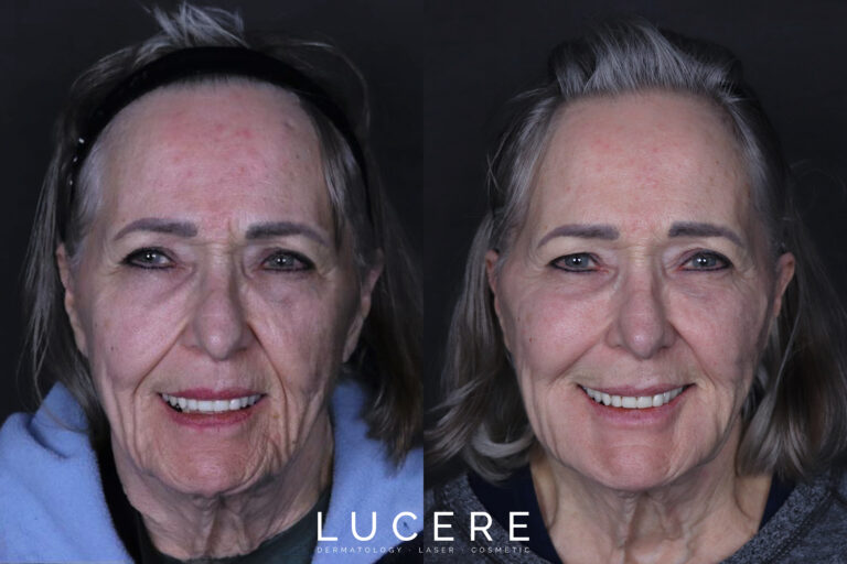 Fillers before and after